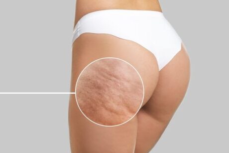 HOW TO DEAL WITH CELLULITE?